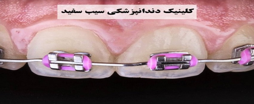 کامپوزیت بهتر است یا ارتودنسی؟